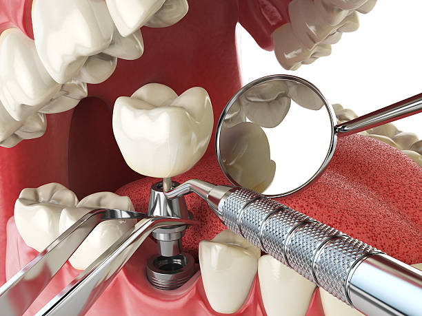 Emergency Dental Filling Replacement in NM